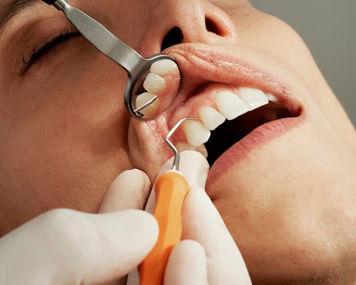Implantes